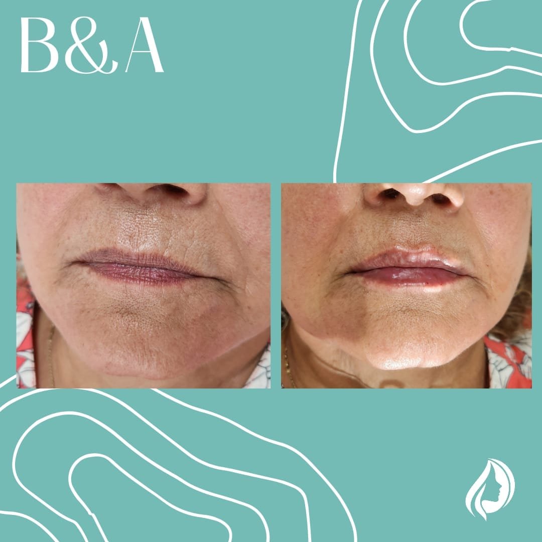 Rellenos faciales labios - Skinvit Aesthetics