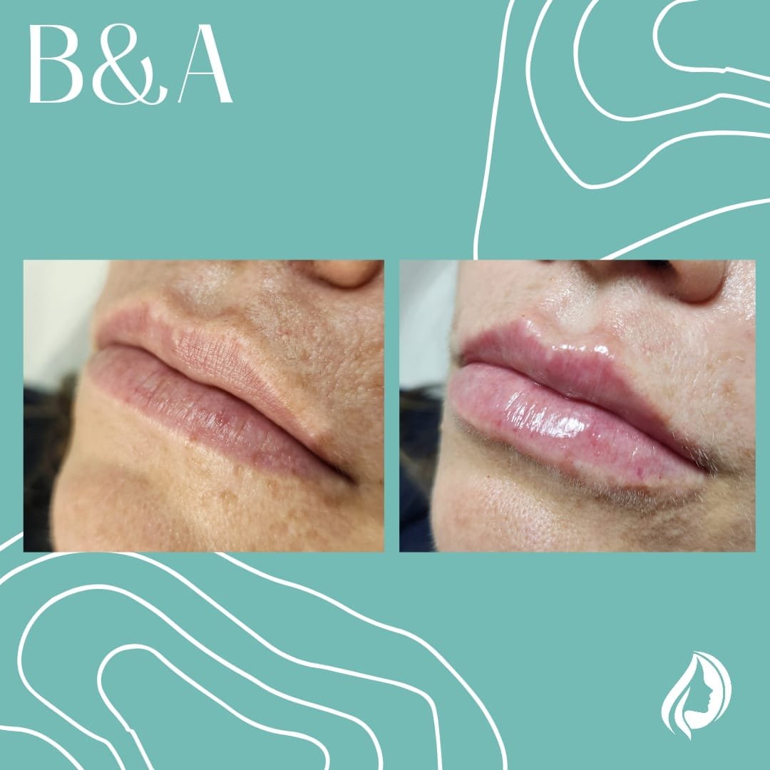 Rellenos faciales labios - Skinvit Aesthetics