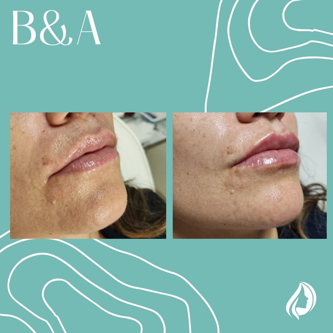 Rellenos faciales labios - Skinvit Aesthetics