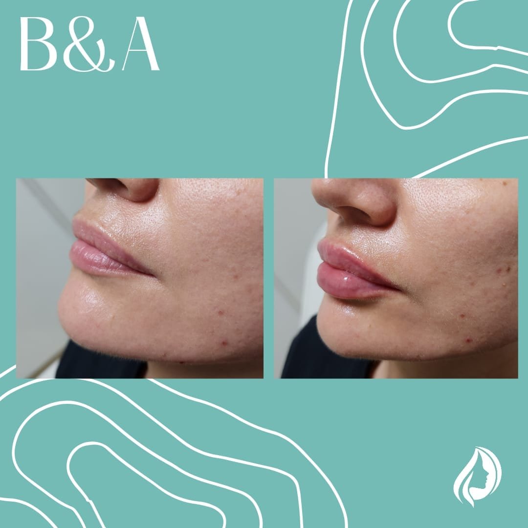 Rellenos faciales labios - Skinvit Aesthetics