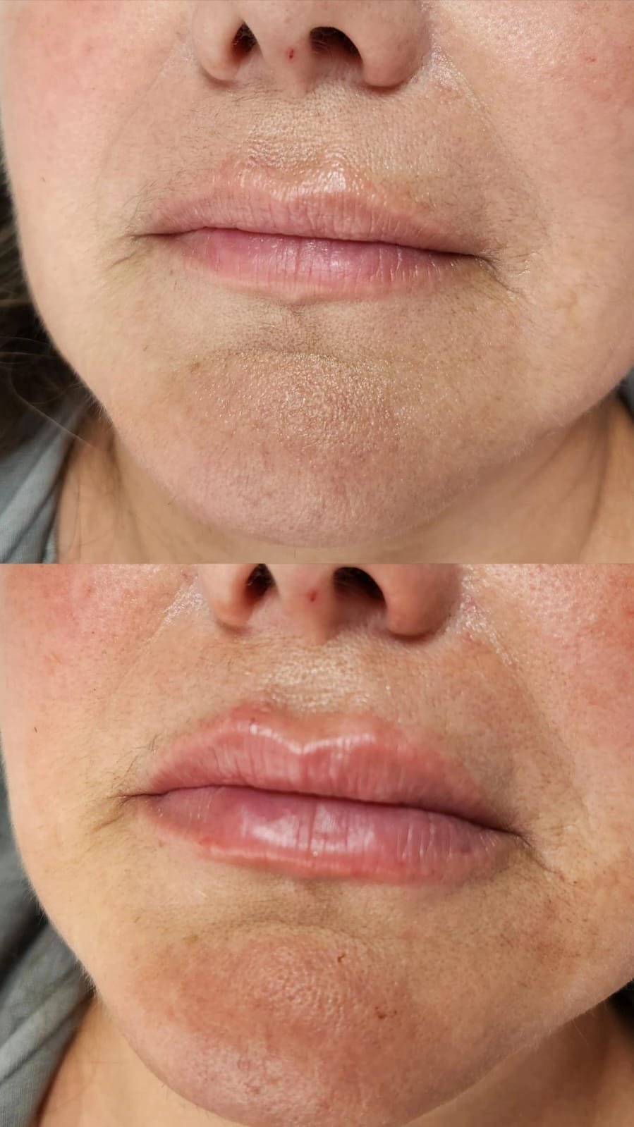 Rellenos faciales labios - Skinvit Aesthetics