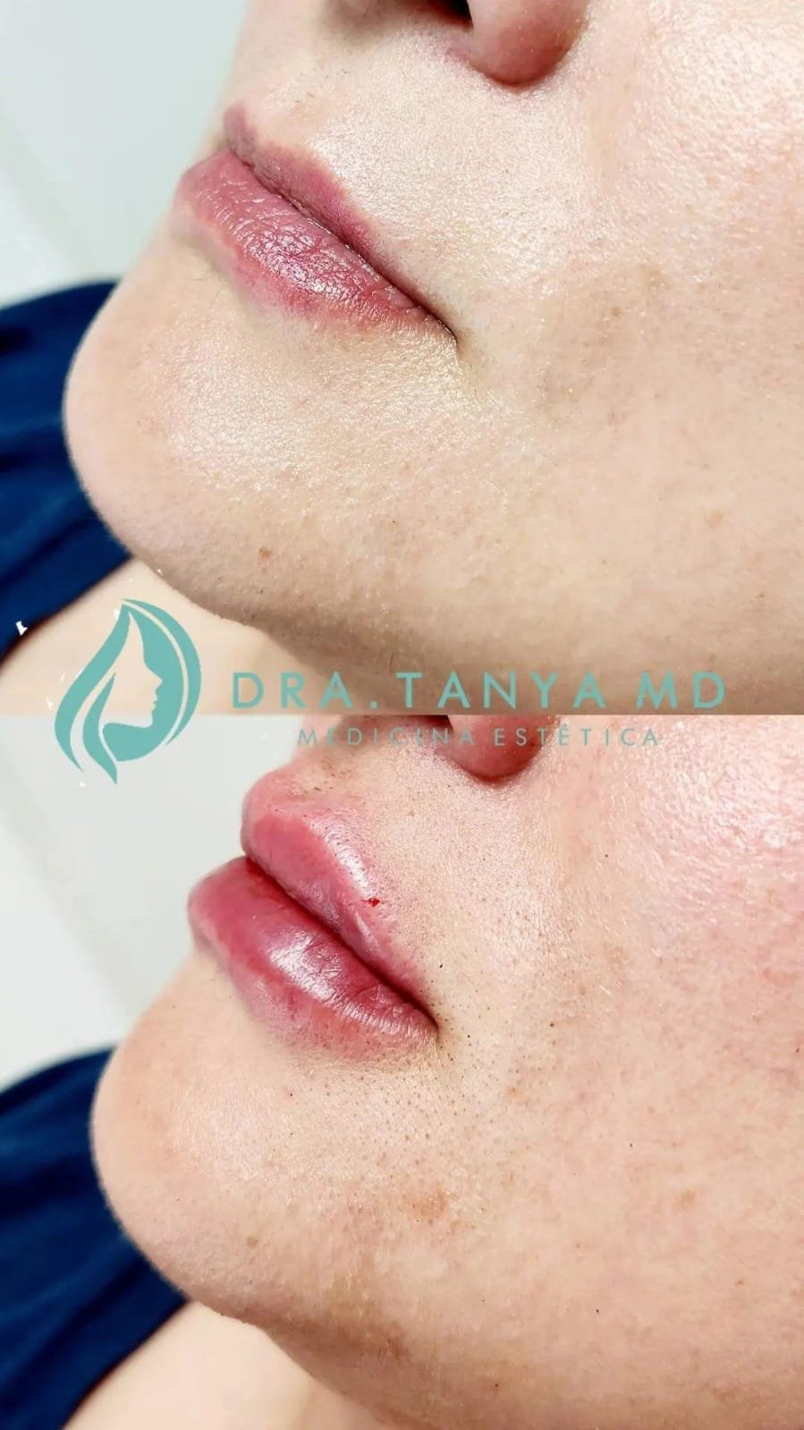 Rellenos faciales labios - Skinvit Aesthetics