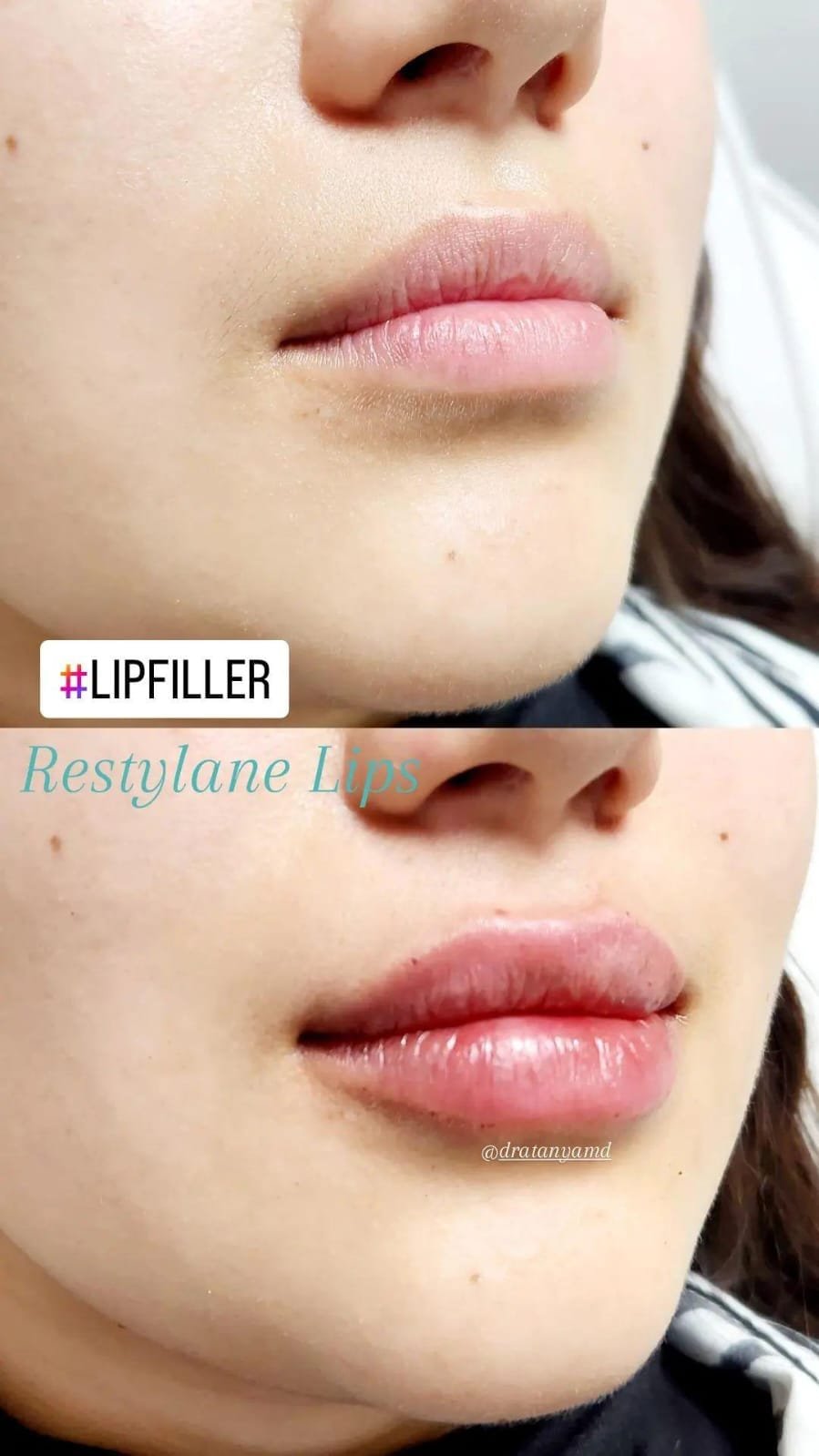 Rellenos faciales labios - Skinvit Aesthetics