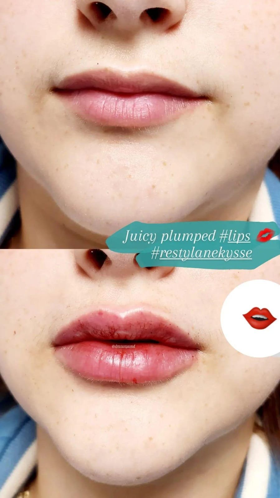 Rellenos faciales labios - Skinvit Aesthetics