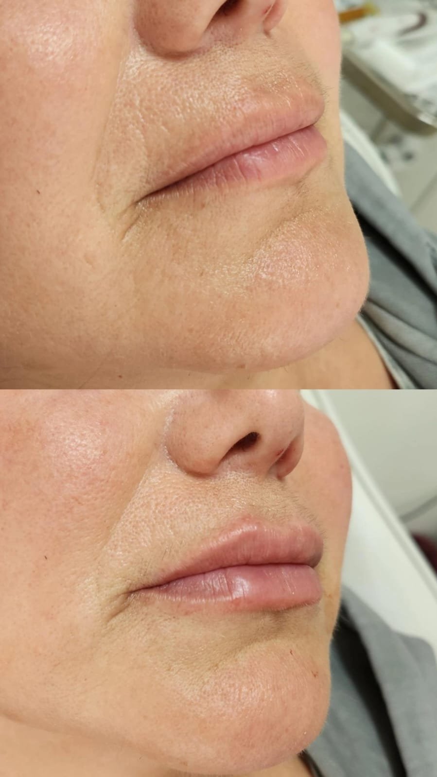 Rellenos faciales labios - Skinvit Aesthetics